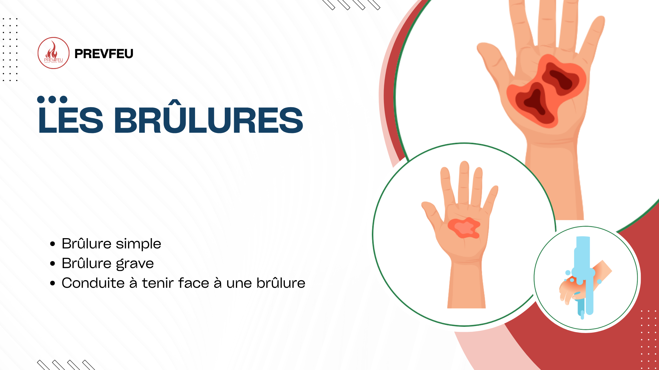 Les brûlures : reconnaître, évaluer et agir